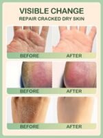 Premium Tea Tree Balm for Dry Skin Body Hand and Foot Care - Image 5